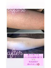 ツリービューティー(Tree Beauty)/メンズ脚　before after