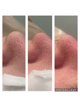 ルナート(Lunart)/毛穴洗浄/毛穴ケア