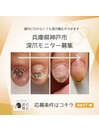 深爪矯正お試しモニター様募集！