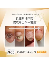 深爪矯正お試しモニター様募集！