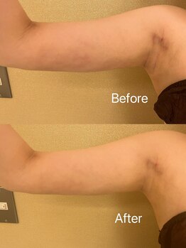 マドモアゼル 麻布十番/痩身インディバ