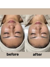 ルアラナ(Lualana)/くすみや毛穴、ムクミには