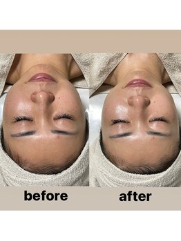 ルアラナ(Lualana)/くすみや毛穴、ムクミには