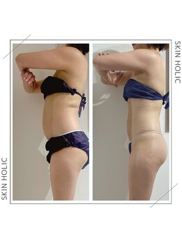 スキンホリック 恵比寿駅前店(SKIN HOLIC)/産後ダイエット！3ヶ月集中！