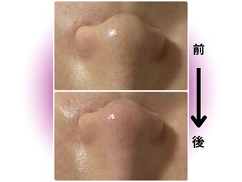 カリアンヌ/毛穴/黒ずみ/ざらつき