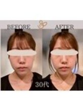 チョコバリ 錦糸町店(chocobari)/小顔×リフトアップ(美容鍼)30代