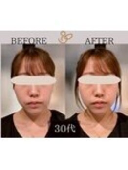 チョコバリ 錦糸町店(chocobari)/小顔×リフトアップ(美容鍼)30代