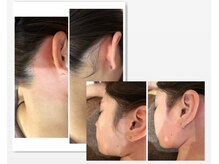 【うなじ・襟足・もみあげとその周辺ワックス＆光脱毛】