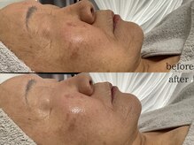 ステラ(Stella)/70代施術症例