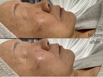 ステラ(Stella)/70代施術症例