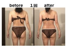 癒しの郷 池袋店/ハイパーナイフ1回痩身