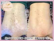 ハーバリー 天王寺(HERBERRY)/ハーブピーリング専門店HERBERRY