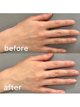 オテテ アイアンドハンド(otete eye&hand)/ハンドケアビフォーアフター