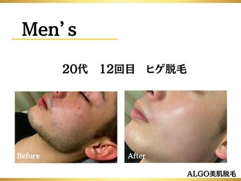 アルゴ 堺東駅前店(ALGO)の写真/髭剃りから解放されたい方へ、最短5ヶ月で脱毛完了！堺東メンズ脱毛専門店