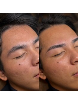 メンズスタジオ リボーン(REBORN)の写真/【第一印象を変える】眉毛・ヒゲ脱毛・毛穴洗浄まで｜松山で人気のメンズ専門サロン