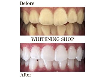 ホワイトニングショップ 明石大久保店/【BeforeAfter】