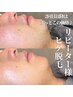 【メンズ脱毛】髭脱毛/鼻から下全て照射(首含む)デザインセレクト当て◎