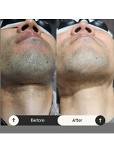 ユーフェム(U-fem)/ヒゲ10回目のお客様