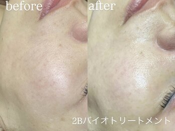 エーアール(ar)/ハーブピーリング/2Bバイオ