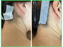 クリア 尾張旭店(Clear)/【Clear脱毛ビフォーアフター】