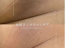 エメ 名古屋栄店(aimer)/LEMELLA <メラニンケア>