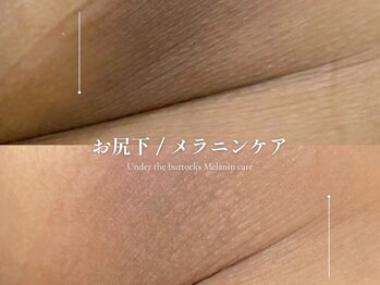 エメ 名古屋栄店(aimer)/LEMELLA <メラニンケア>