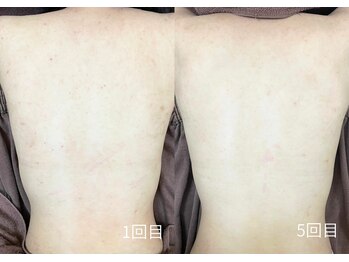 エミルカ 日の出平井店(EMILUCA)/剥離なしハーブ５回で綺麗に♪