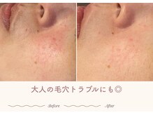 エステティックサロン シーズ/大人の毛穴トラブルにも◎