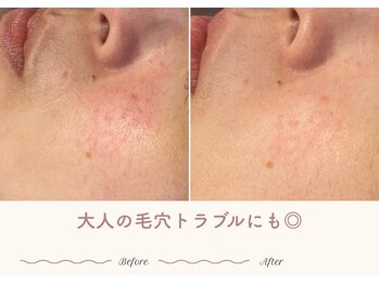 エステティックサロン シーズ/大人の毛穴トラブルにも◎