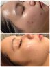 人気No.2☆本気で肌改善！ありなし選べるハーブピーリング【10回】¥75000◎