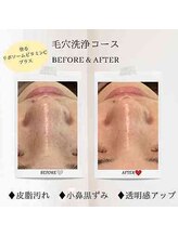 エクラ アン(eclat.un)/20代女性：毛穴洗浄コース