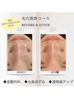 エクラ アン(eclat.un)/20代女性：毛穴洗浄コース