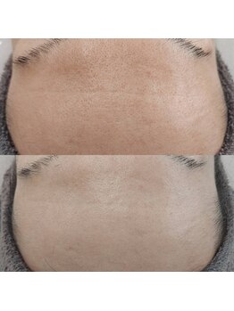 ヴェルシック(Belchic)/眉間の毛穴とおでこのシワも改善