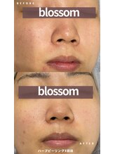 ブロッサム(Blossom)/