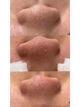 ラルガ 城野店(Raruga)/毛穴洗浄