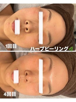 グレース(GRACE)/ハーブピーリング