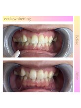 エクシアホワイト 倉吉店(ecxia white)/ビフォーアフター
