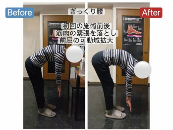 アンティオール 札幌店/50代女性　ぎっくり