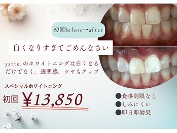 ヤット 森ノ宮(yatto.)/初回スペシャルホワイトニング