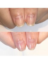 キュア(Cure.)/剥離爪の為の地爪育成ケア