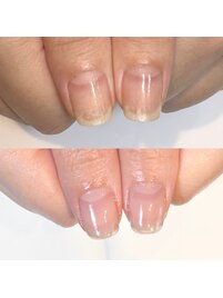 剥離爪の為の地爪育成ケア