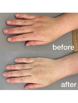 オテテ アイアンドハンド(otete eye&hand)/ハンドケアビフォーアフター