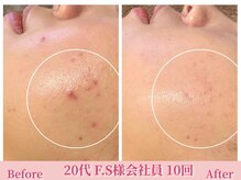 アメリイ 百合ヶ丘 新百合ヶ丘(Amerii)/ハーブピーリング/ニキビ/毛穴