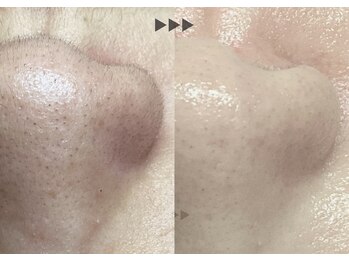 ソーヴ(SOLVE)の写真/毛穴悩み、実は『毛』かも！黒ずみ毛穴、開き毛穴、たるみ毛穴、タイプ別に毛穴ケア♪