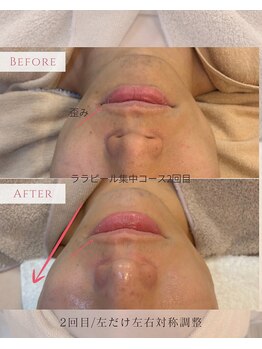 ジーンバイピエル 中野店(gene by PIEL)の写真/【韓国肌管理/小顔】むくみ・赤み・水分乱れを整え別人級小顔へ【水玉リフティング/中野/高円寺/新宿】
