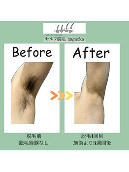 ナガオカ 今朝白店(nagaoka)/脇の脱毛/BeforeAfter
