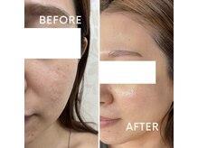 バーグトータルビューティー(bague total beauty)/光フェイシャル