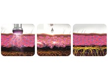 エステサロン ジジ 新宿(JIJI)/ハーブピーリング、プラズマ新宿