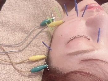モッチ 天神大名店(MOCCHI)の写真/【速攻小顔◎】プロによる美容鍼でお顔・お肌のお悩みを解決！速攻性・持続性の高いシャープな小顔へ