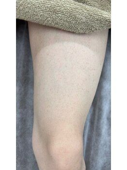 アンビー(Ambee)/太もも【メンズ脱毛】